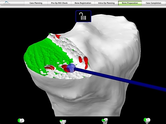 Computertomographie eines Kniegelenks mit Anzeige von defekten Stellen